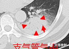 影像PPT - 【病例】鹦鹉热衣原体肺炎1例CT影像-14 影像PPT - 【病例】鹦鹉热衣原体肺炎1例CT影像-14
