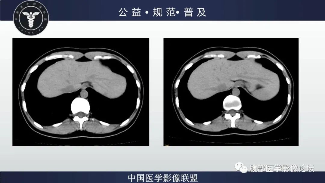 影像PPT - 【病例】肝细胞肝癌1例CT及MR-5