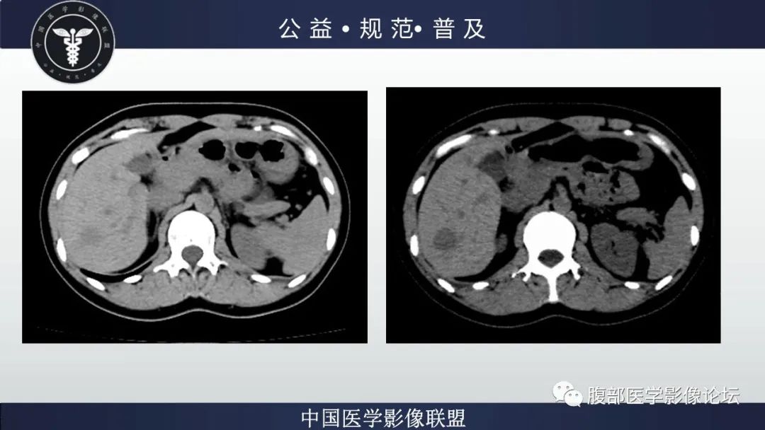 影像PPT - 【病例】肝细胞肝癌1例CT及MR-3
