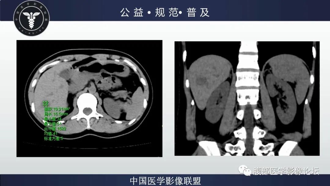 影像PPT - 【病例】肝细胞肝癌1例CT及MR-4