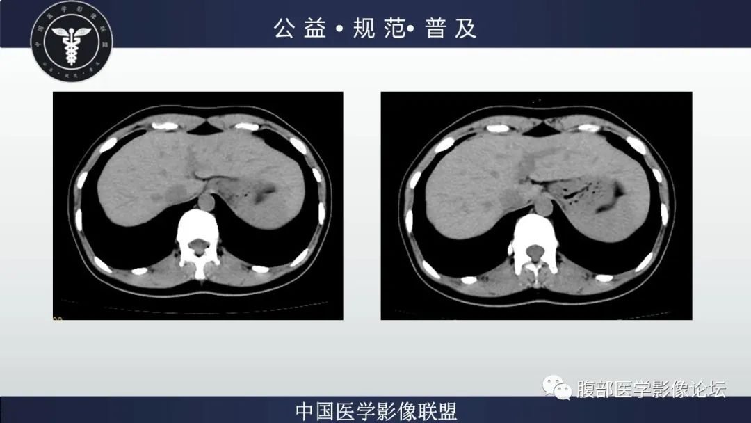 影像PPT - 【病例】肝细胞肝癌1例CT及MR-6