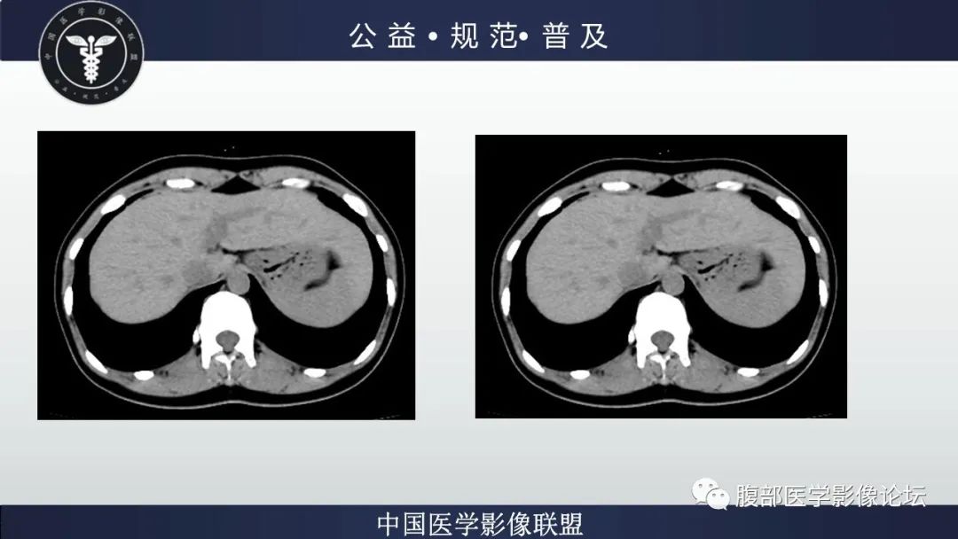 影像PPT - 【病例】肝细胞肝癌1例CT及MR-7