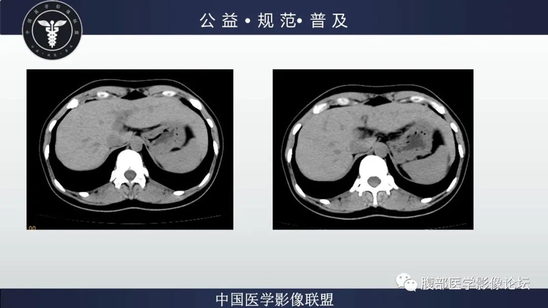 影像PPT - 【病例】肝细胞肝癌1例CT及MR-8