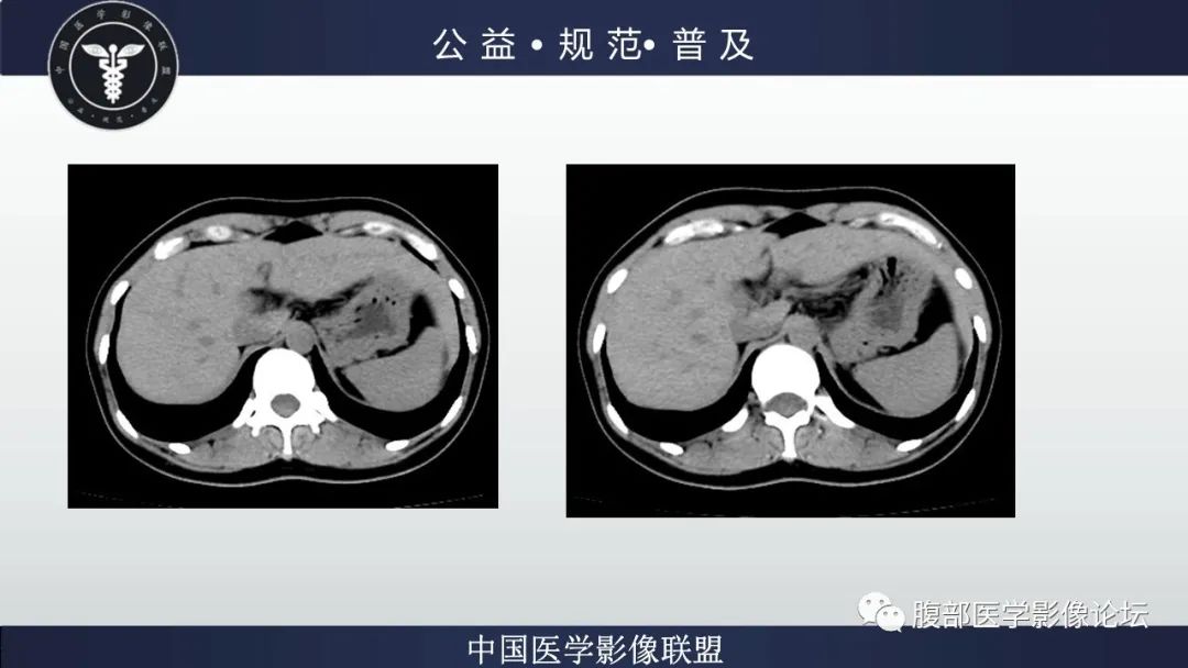 影像PPT - 【病例】肝细胞肝癌1例CT及MR-9