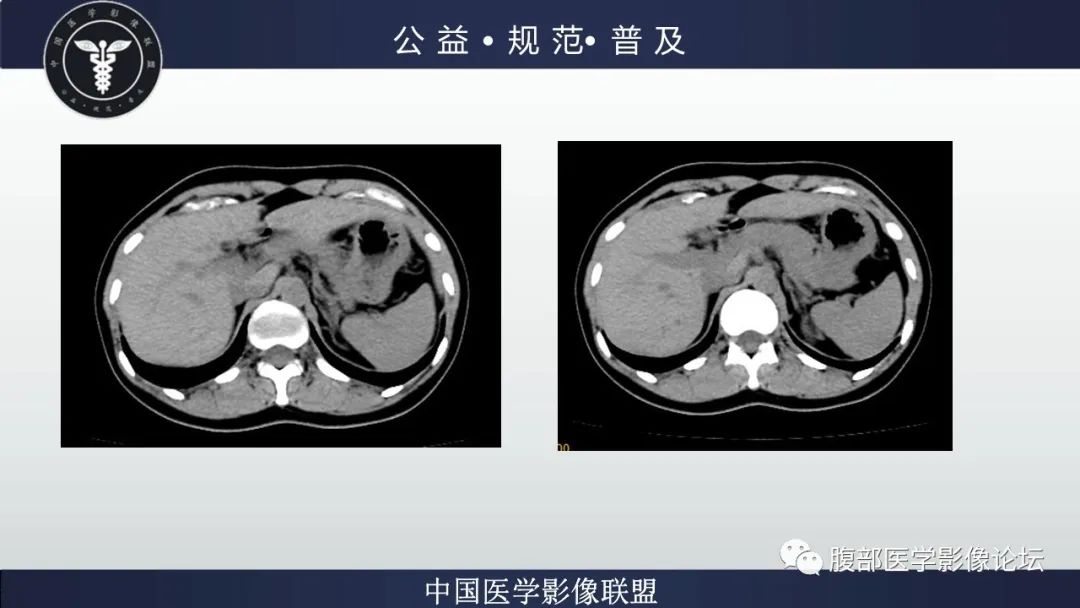影像PPT - 【病例】肝细胞肝癌1例CT及MR-10