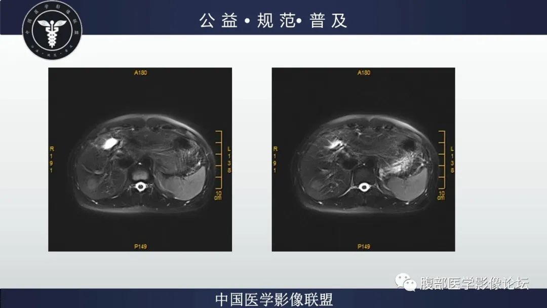 影像PPT - 【病例】肝细胞肝癌1例CT及MR-11