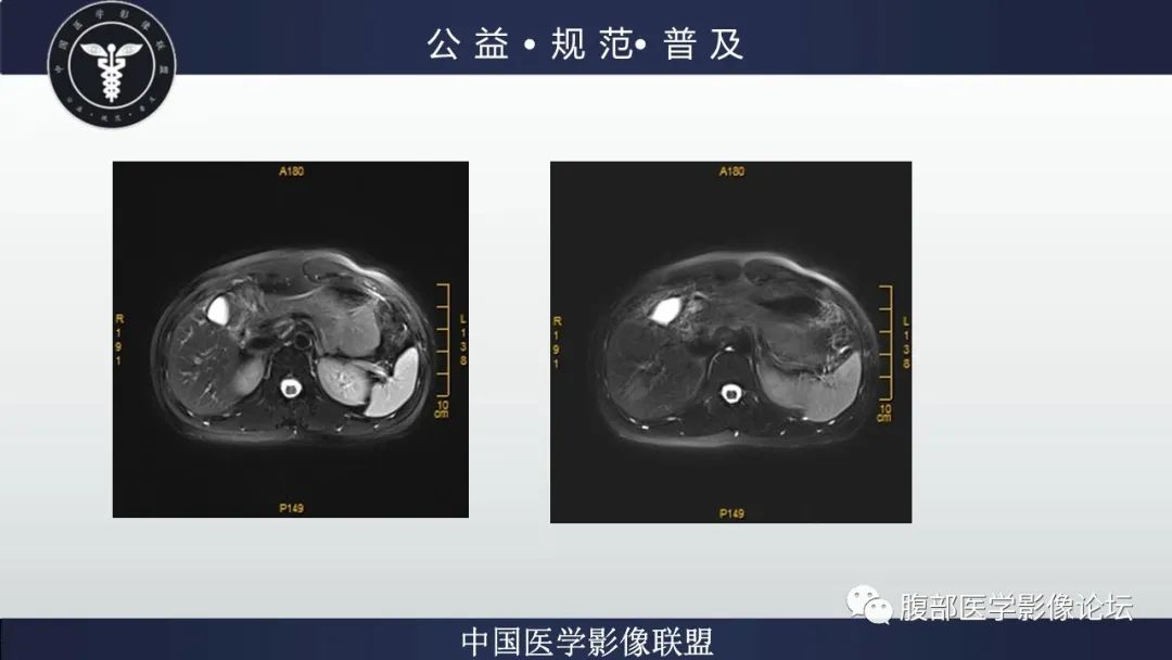 影像PPT - 【病例】肝细胞肝癌1例CT及MR-12