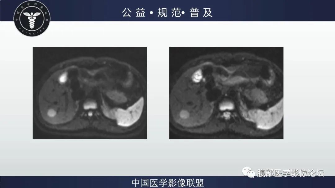 影像PPT - 【病例】肝细胞肝癌1例CT及MR-13