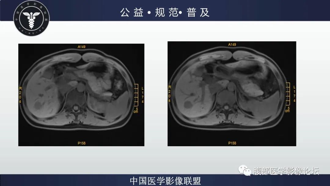 影像PPT - 【病例】肝细胞肝癌1例CT及MR-15