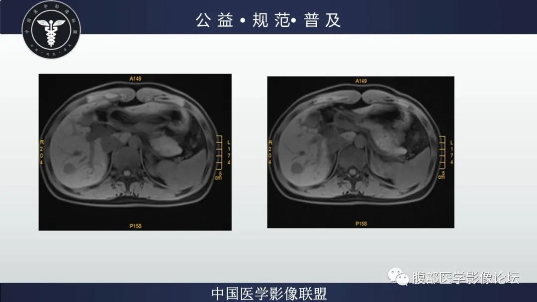 影像PPT - 【病例】肝细胞肝癌1例CT及MR-16