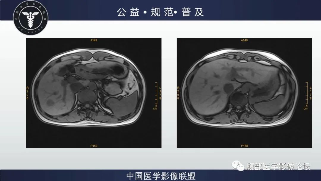 影像PPT - 【病例】肝细胞肝癌1例CT及MR-17