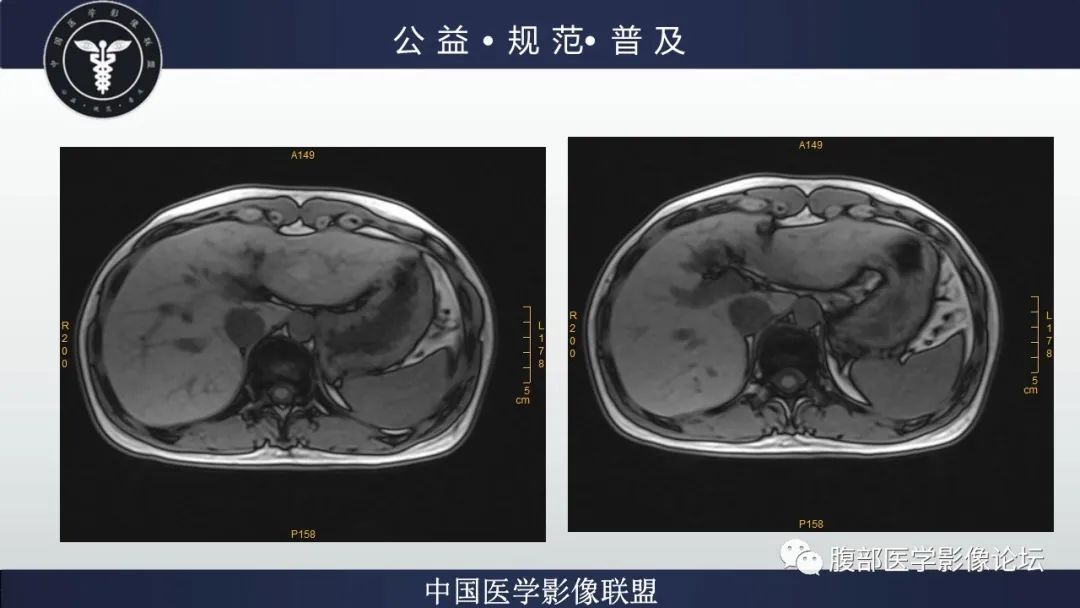 影像PPT - 【病例】肝细胞肝癌1例CT及MR-18