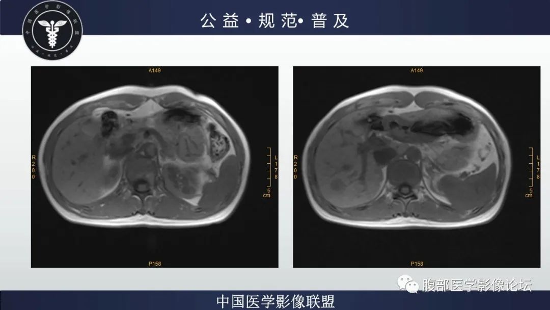 影像PPT - 【病例】肝细胞肝癌1例CT及MR-19