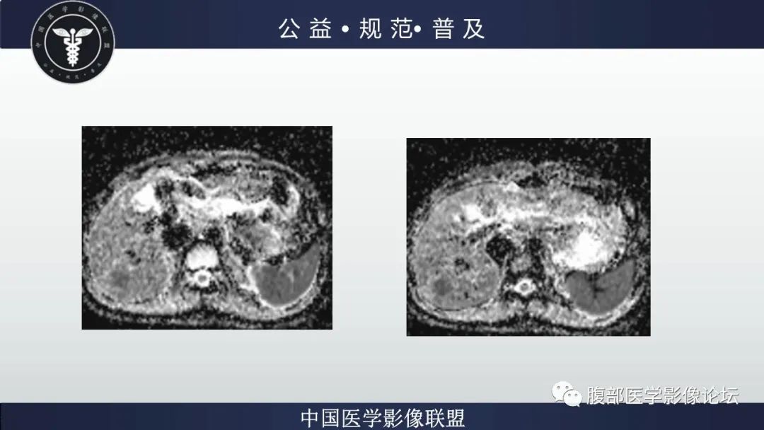 影像PPT - 【病例】肝细胞肝癌1例CT及MR-14