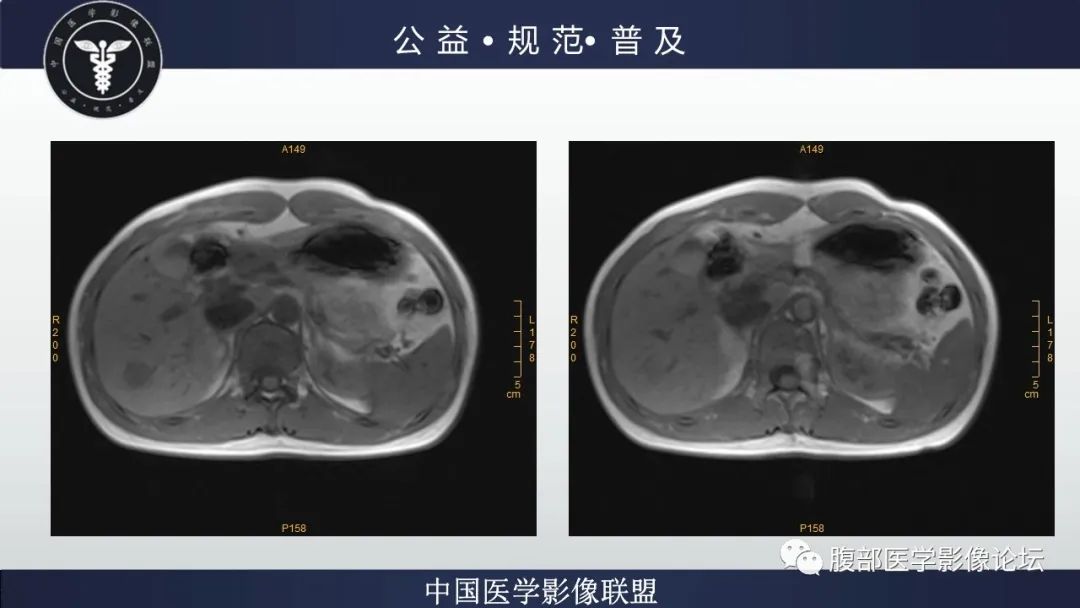 影像PPT - 【病例】肝细胞肝癌1例CT及MR-20