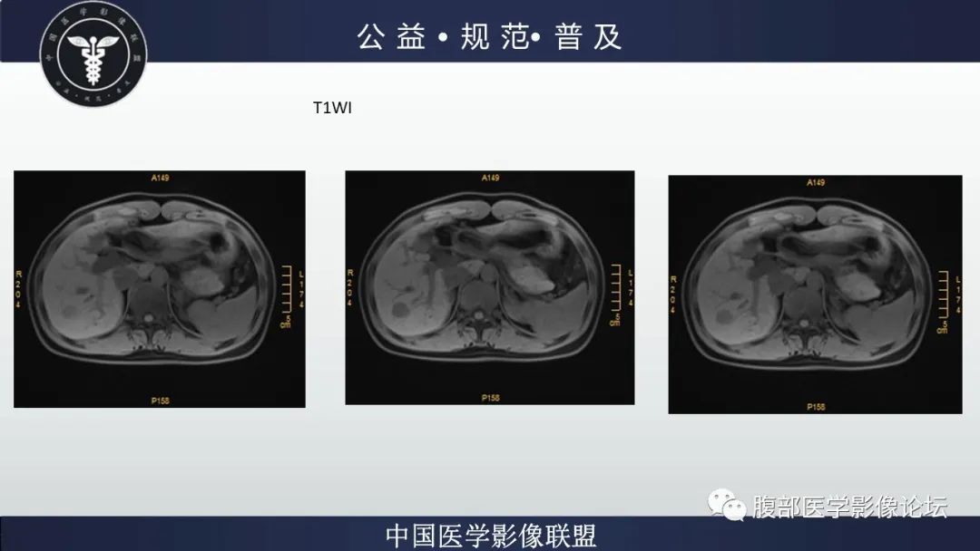 影像PPT - 【病例】肝细胞肝癌1例CT及MR-21