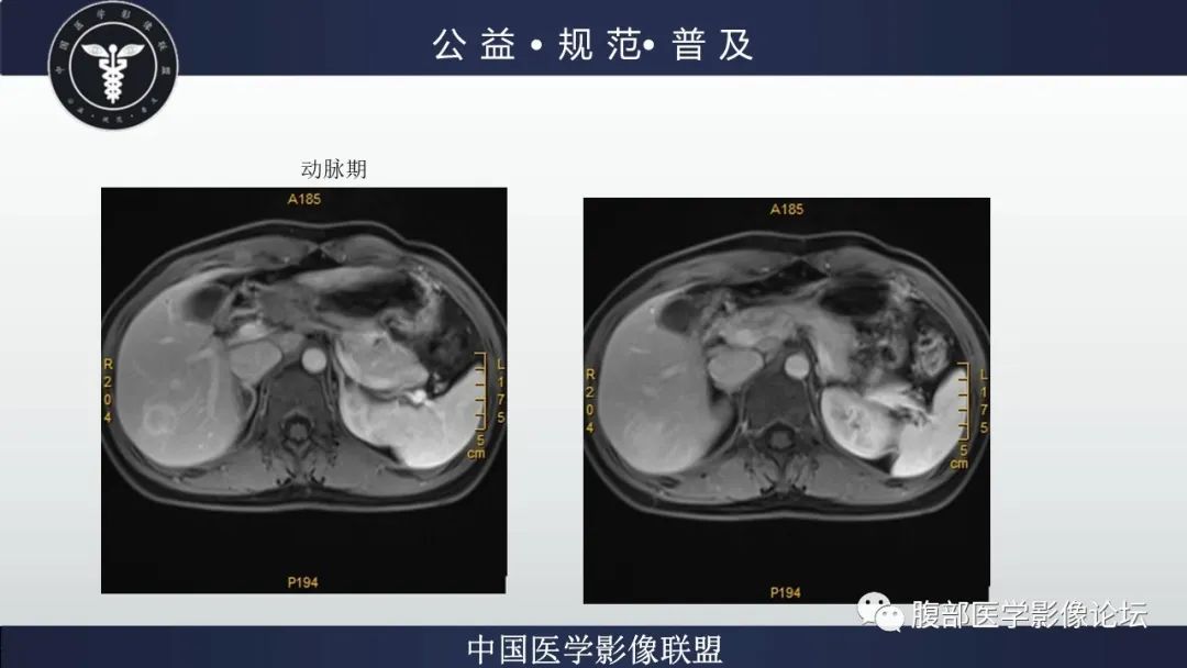 影像PPT - 【病例】肝细胞肝癌1例CT及MR-22
