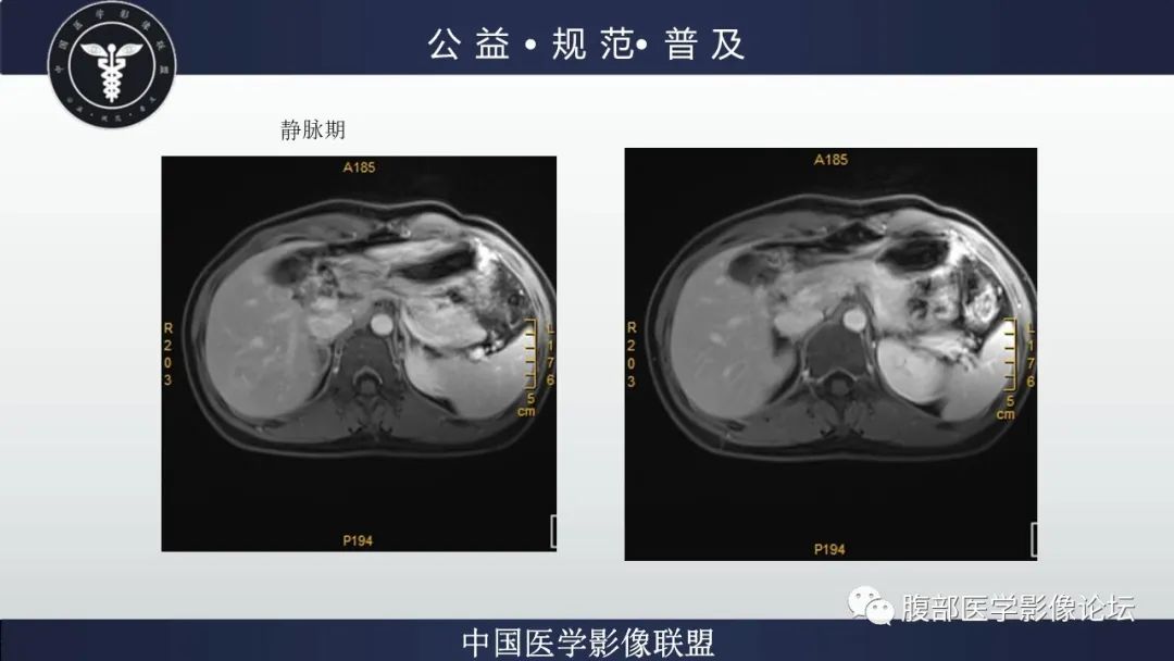 影像PPT - 【病例】肝细胞肝癌1例CT及MR-23