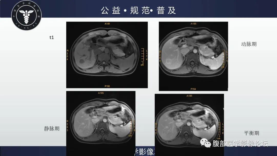 影像PPT - 【病例】肝细胞肝癌1例CT及MR-25
