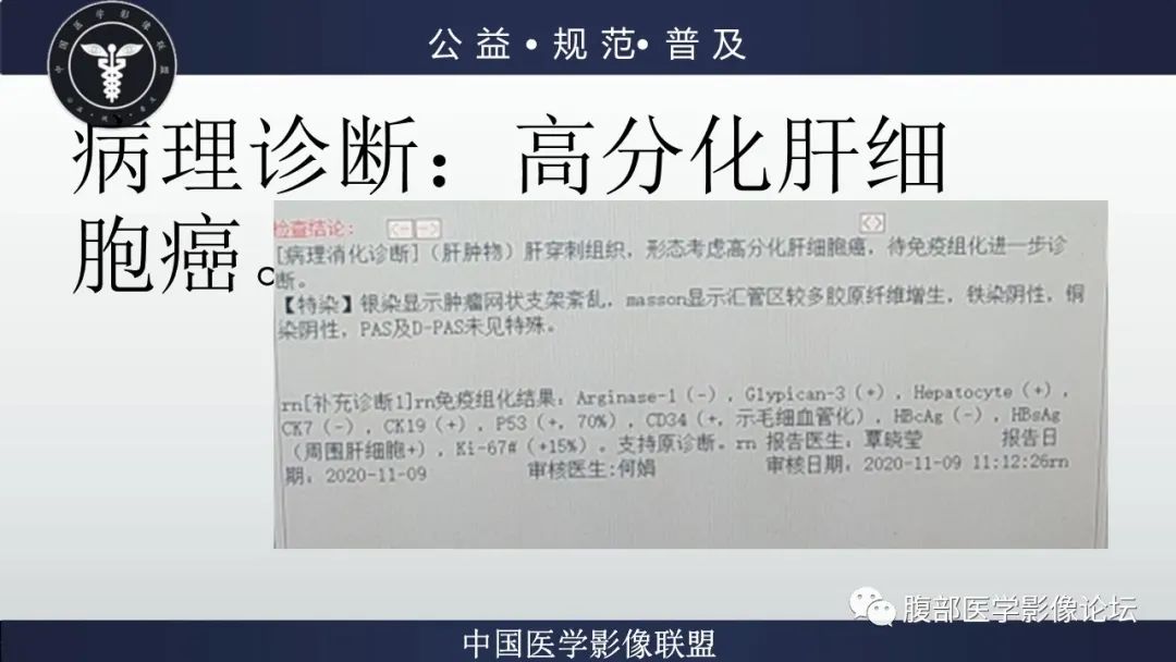 影像PPT - 【病例】肝细胞肝癌1例CT及MR-26