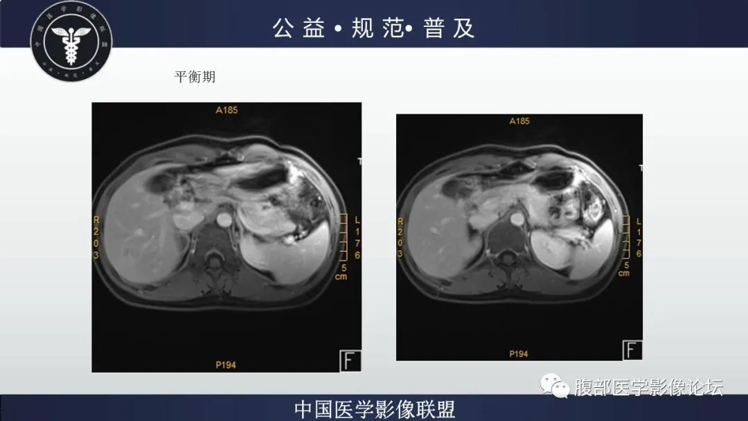 影像PPT - 【病例】肝细胞肝癌1例CT及MR-24