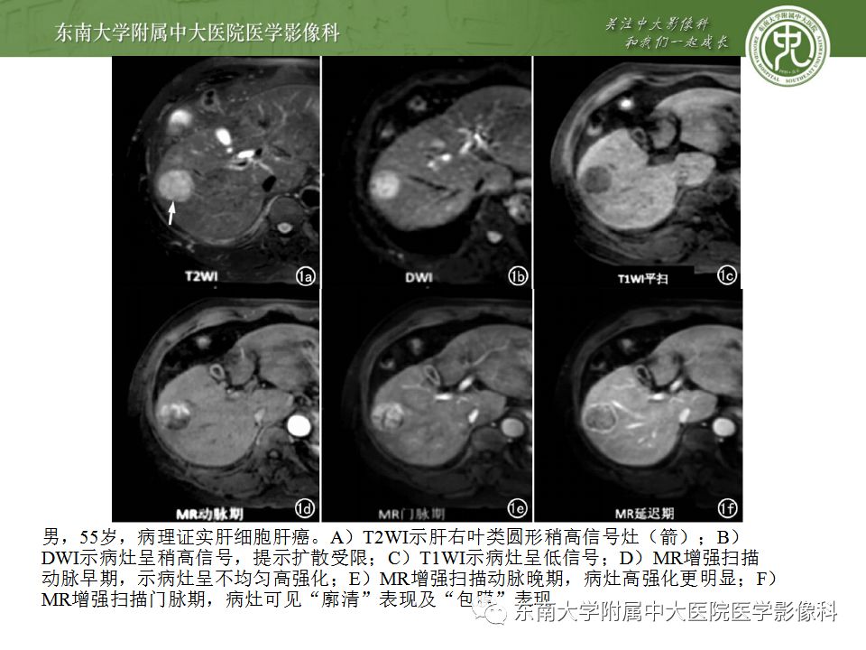 影像PPT - 【病例】肝细胞肝癌1例CT及MR-31