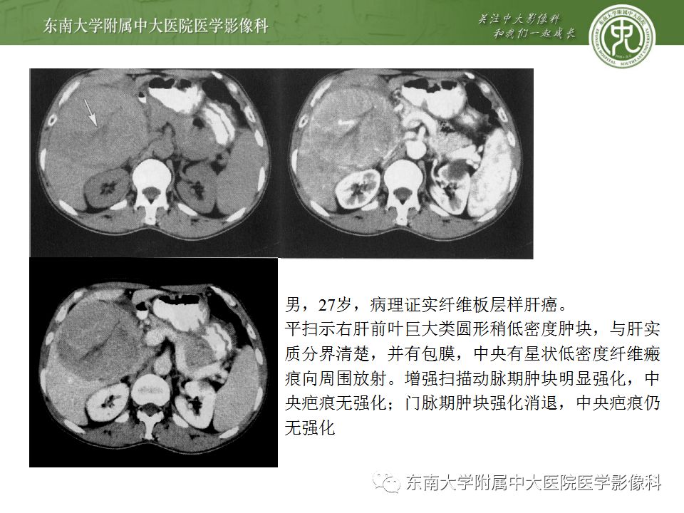 影像PPT - 【病例】肝细胞肝癌1例CT及MR-33