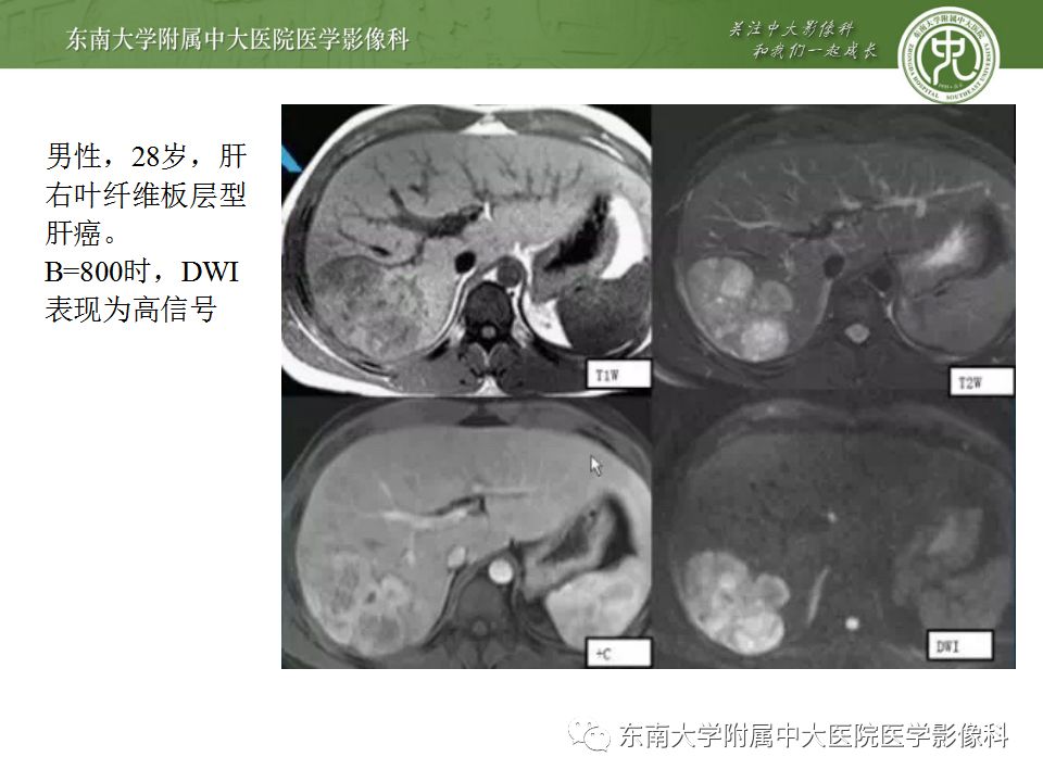 影像PPT - 【病例】肝细胞肝癌1例CT及MR-34