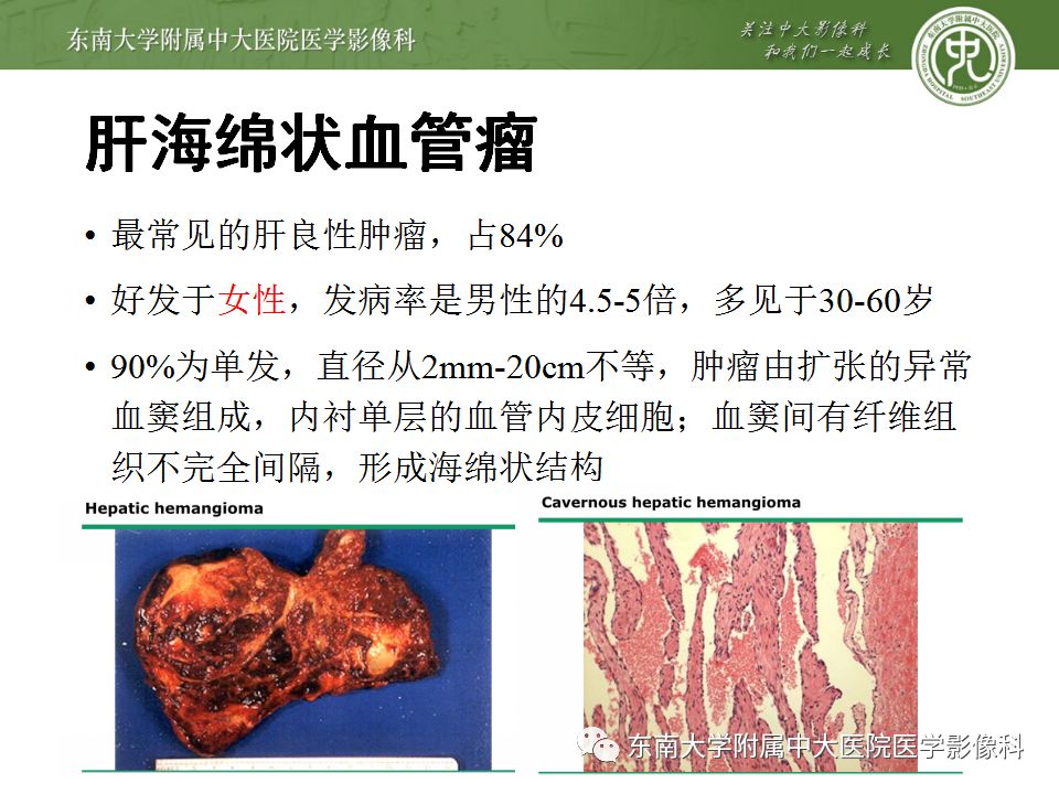 影像PPT - 【病例】肝细胞肝癌1例CT及MR-37