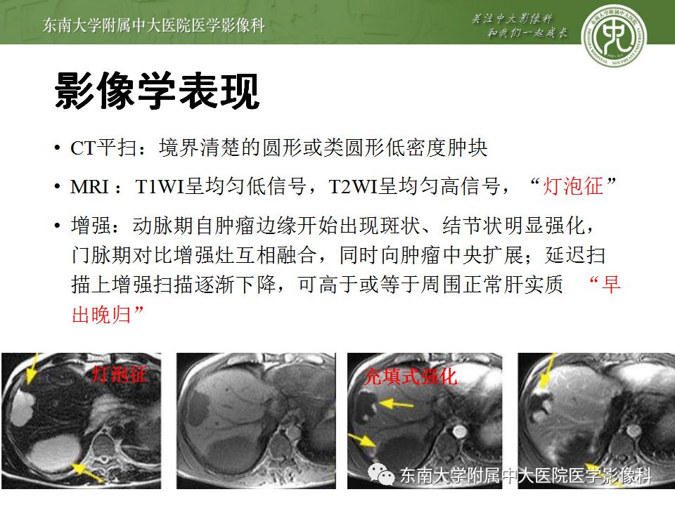 影像PPT - 【病例】肝细胞肝癌1例CT及MR-38