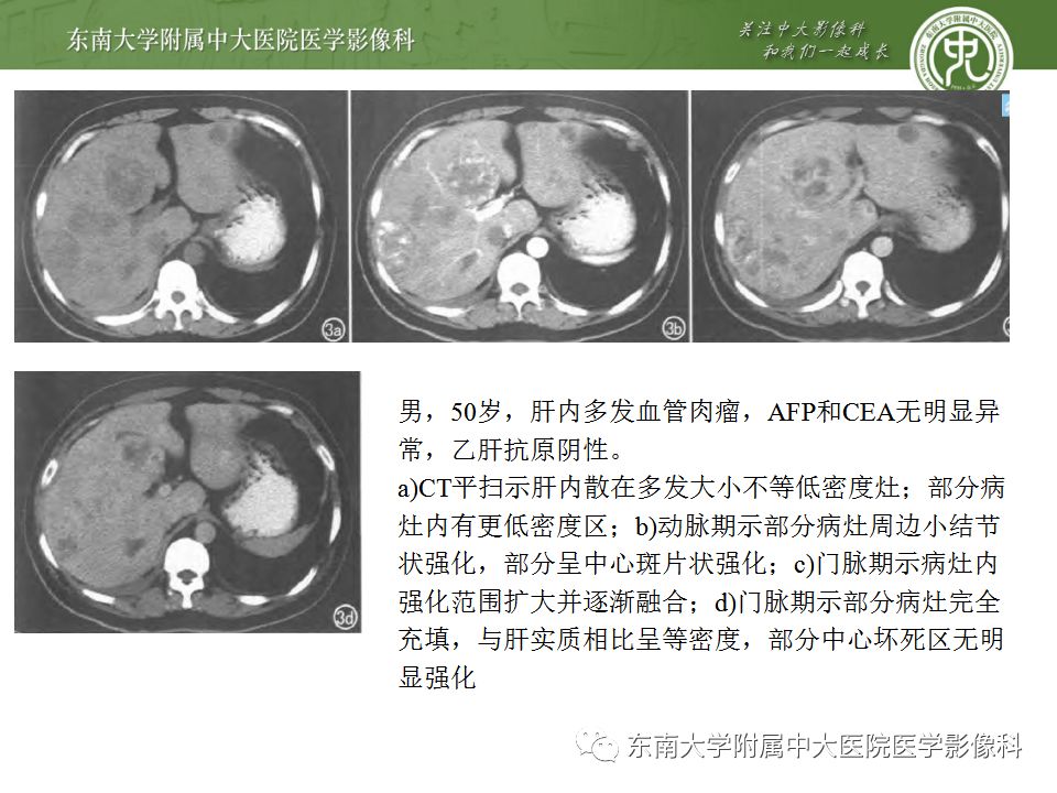 影像PPT - 【病例】肝细胞肝癌1例CT及MR-36