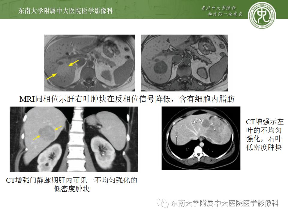 影像PPT - 【病例】肝细胞肝癌1例CT及MR-41