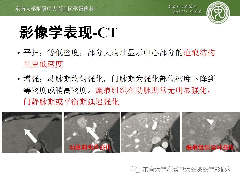 影像PPT - 【病例】肝细胞肝癌1例CT及MR-43