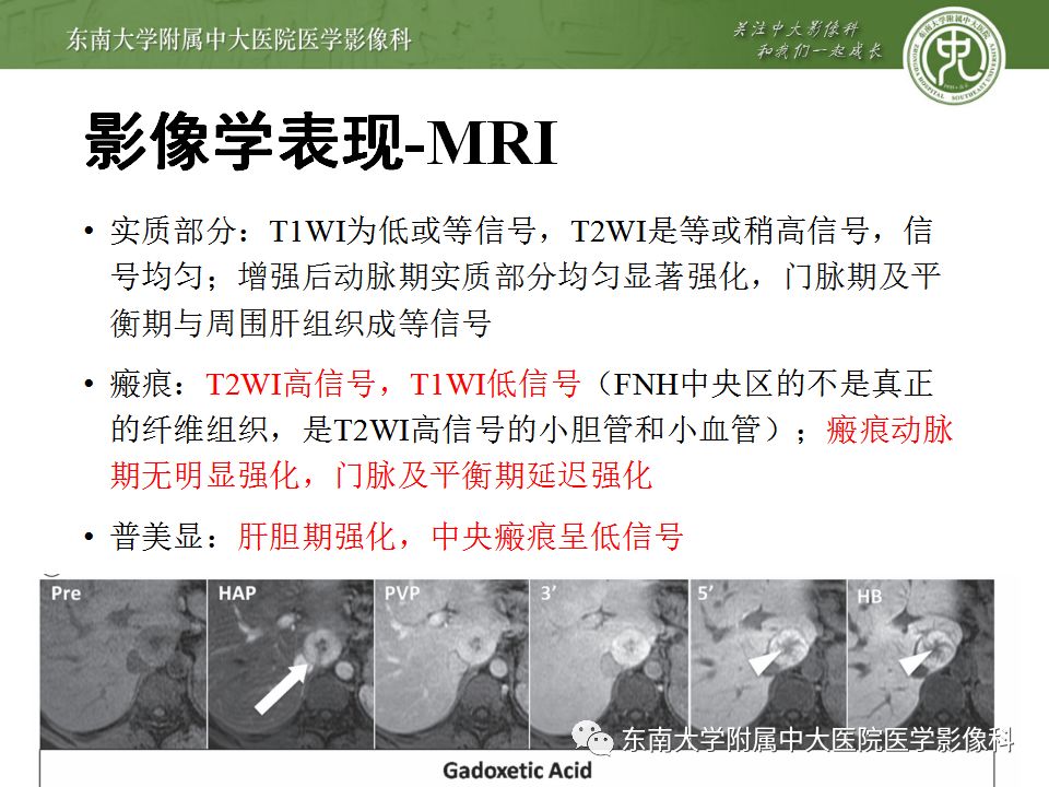 影像PPT - 【病例】肝细胞肝癌1例CT及MR-44