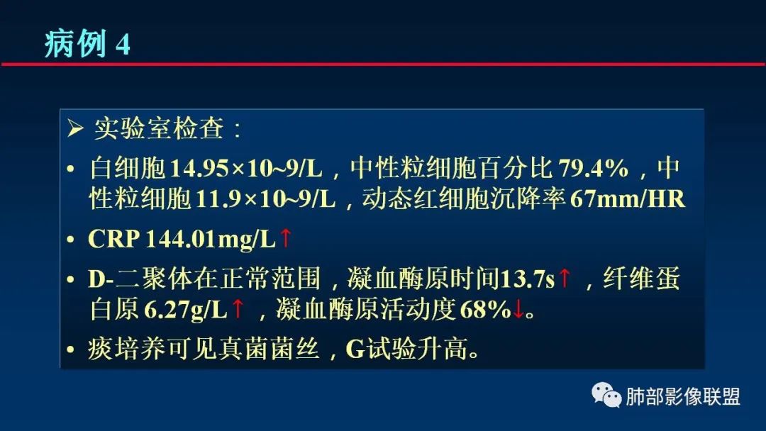 影像PPT - 【PPT】肺梗死的影像解析-21 影像PPT - 【PPT】肺梗死的影像解析-21