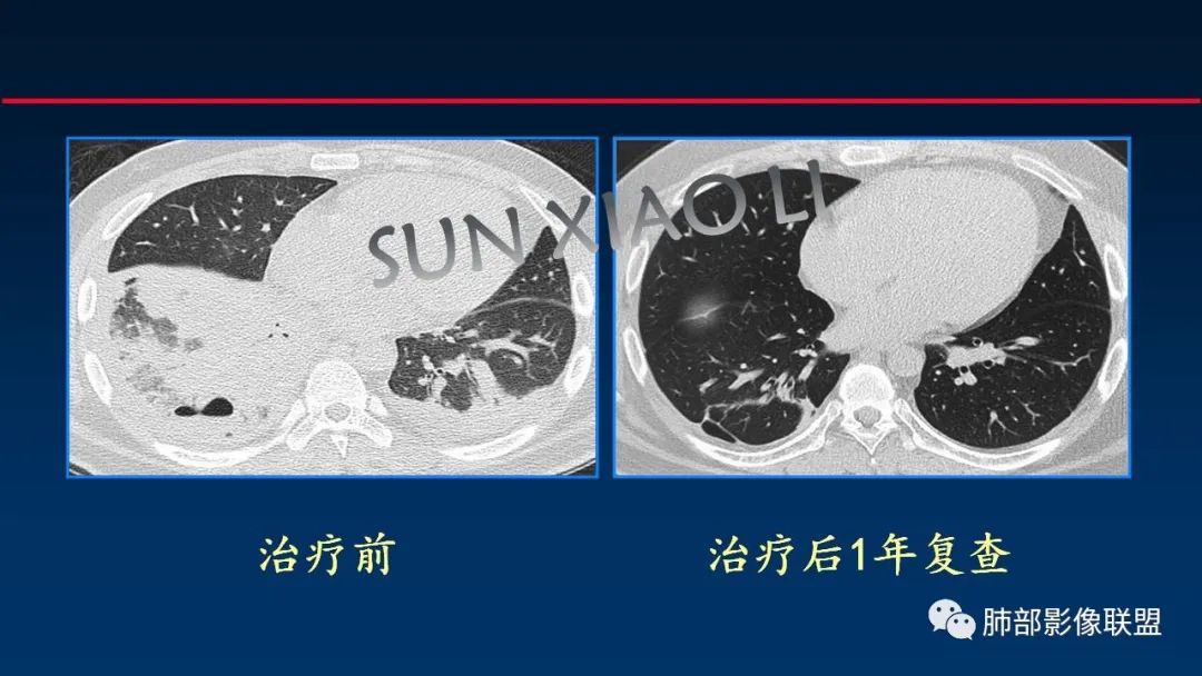影像PPT - 【PPT】肺梗死的影像解析-31 影像PPT - 【PPT】肺梗死的影像解析-31
