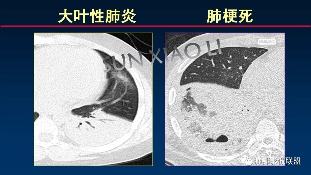 影像PPT - 【PPT】肺梗死的影像解析-34 影像PPT - 【PPT】肺梗死的影像解析-34