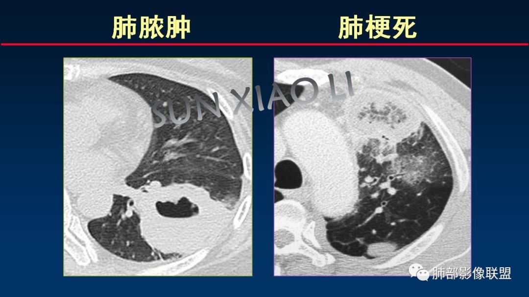 影像PPT - 【PPT】肺梗死的影像解析-35 影像PPT - 【PPT】肺梗死的影像解析-35