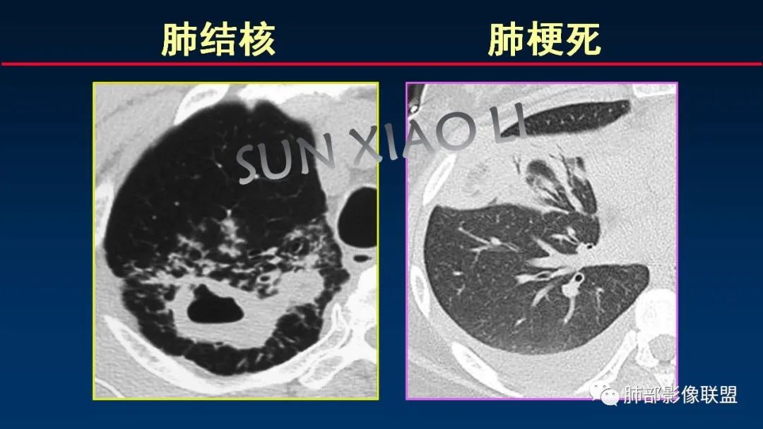 影像PPT - 【PPT】肺梗死的影像解析-36 影像PPT - 【PPT】肺梗死的影像解析-36
