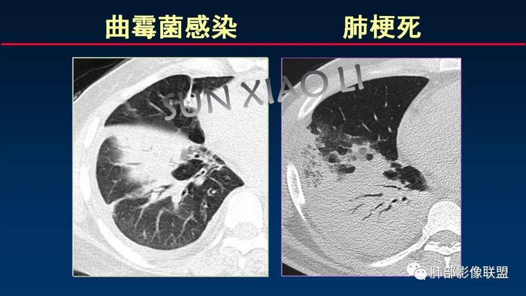 影像PPT - 【PPT】肺梗死的影像解析-37 影像PPT - 【PPT】肺梗死的影像解析-37