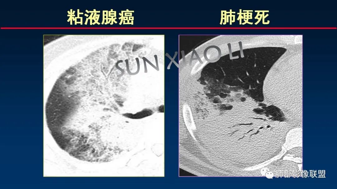 影像PPT - 【PPT】肺梗死的影像解析-39 影像PPT - 【PPT】肺梗死的影像解析-39