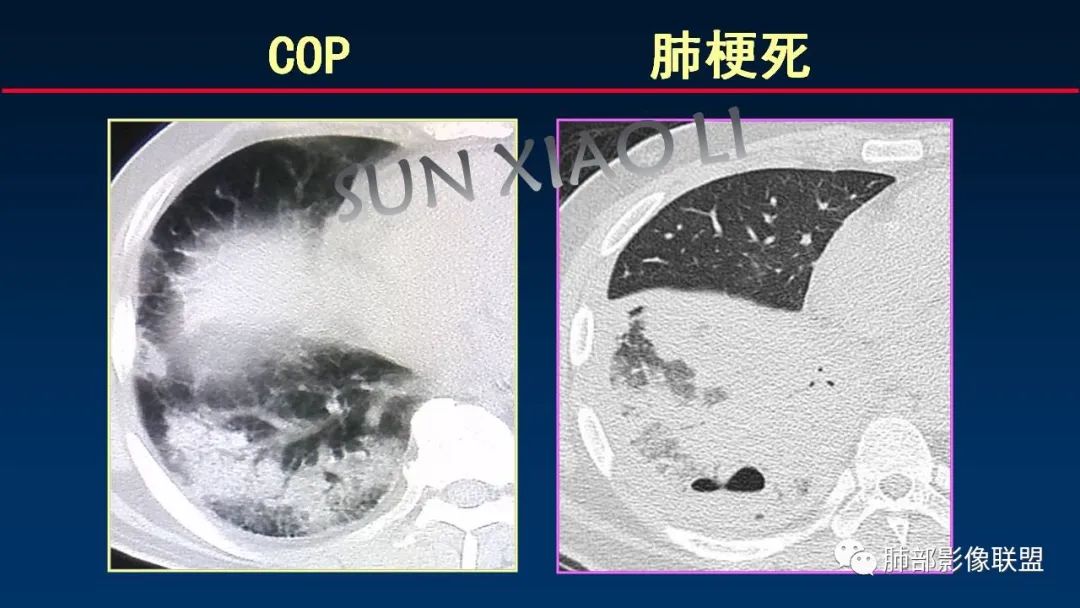 影像PPT - 【PPT】肺梗死的影像解析-38 影像PPT - 【PPT】肺梗死的影像解析-38