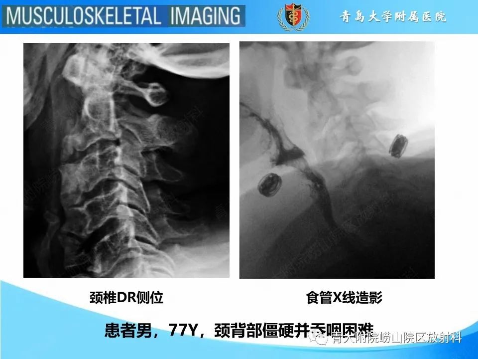 影像PPT - 【PPT】弥漫性特发性骨肥厚-2