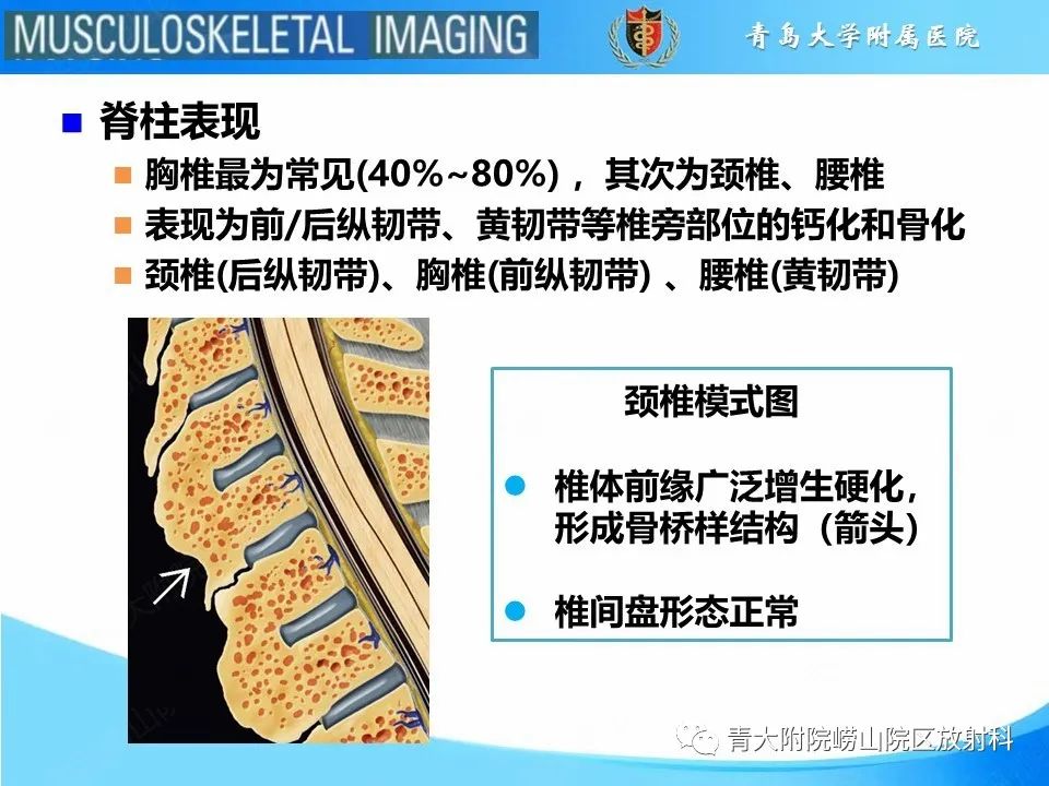 影像PPT - 【PPT】弥漫性特发性骨肥厚-7