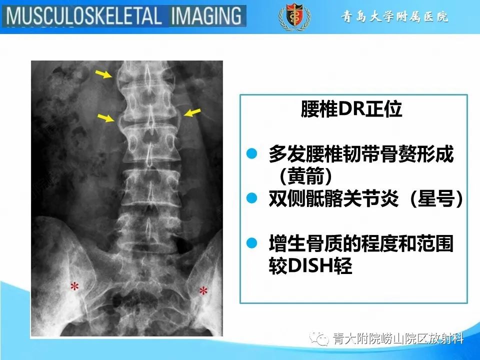 影像PPT - 【PPT】弥漫性特发性骨肥厚-9