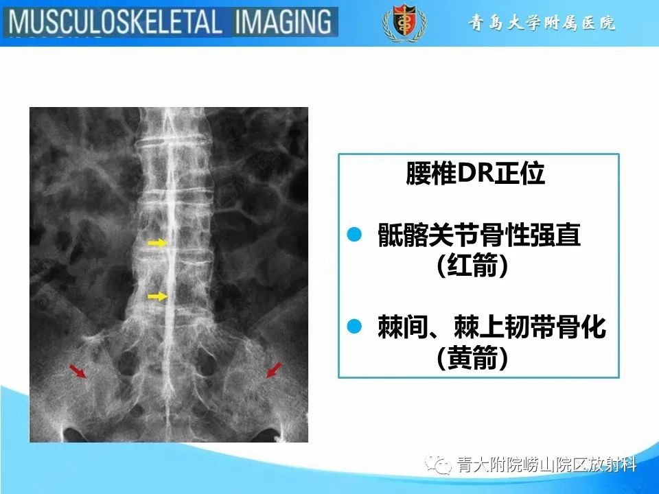 影像PPT - 【PPT】弥漫性特发性骨肥厚-11
