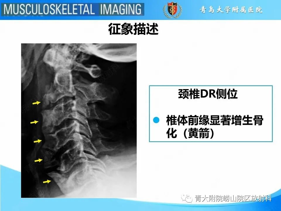 影像PPT - 【PPT】弥漫性特发性骨肥厚-20