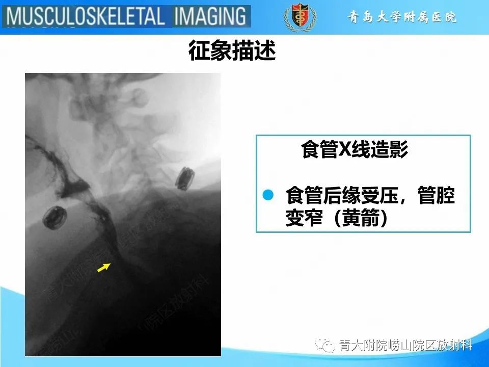 影像PPT - 【PPT】弥漫性特发性骨肥厚-21