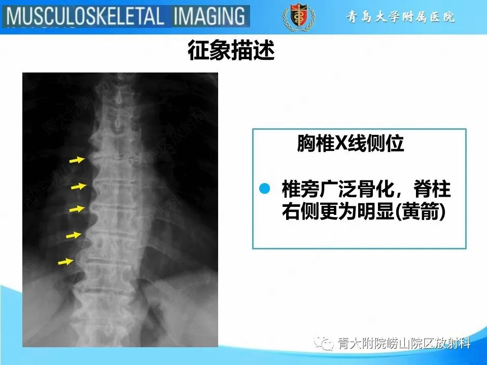 影像PPT - 【PPT】弥漫性特发性骨肥厚-22