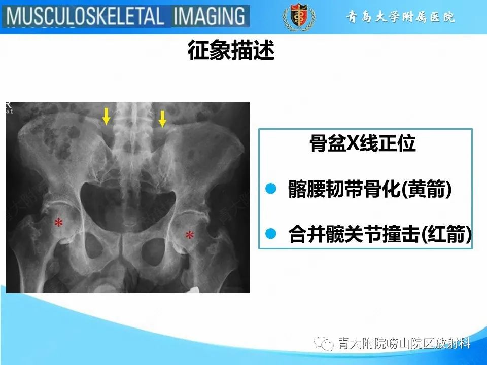 影像PPT - 【PPT】弥漫性特发性骨肥厚-23